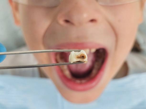 Best Knocked-Out Tooth Emergency  in Caseyvle, IL